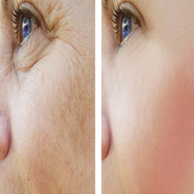Electrocautery & Radiocautery